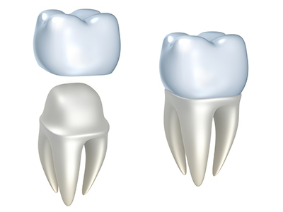 3D images of two dental crowns.