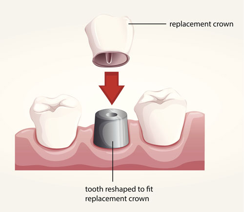 Diagram of dental crowns with varying placement