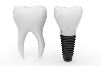 Image of dental implant and molar.