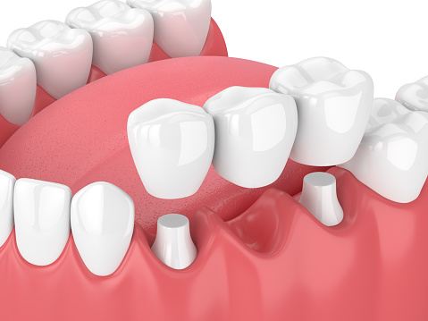 Dental bridge being placed in diagram of lower teeth