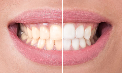 Photo of patient's teeth whitening done at  The Center for Esthetic Dentistry in Grants Pass, OR