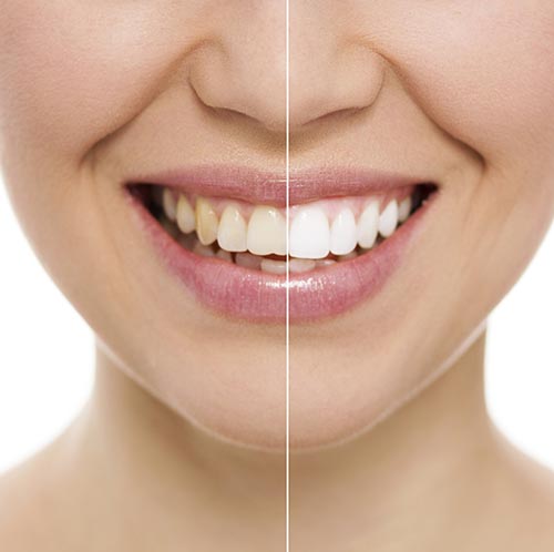 Discolored Teeth And Self Esteem: How Are They Related?