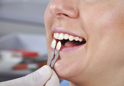 Image of a dental professional placing a veneer in a patient's mouth, at The Center for Esthetic Dentistry in Grants Pass, OR.