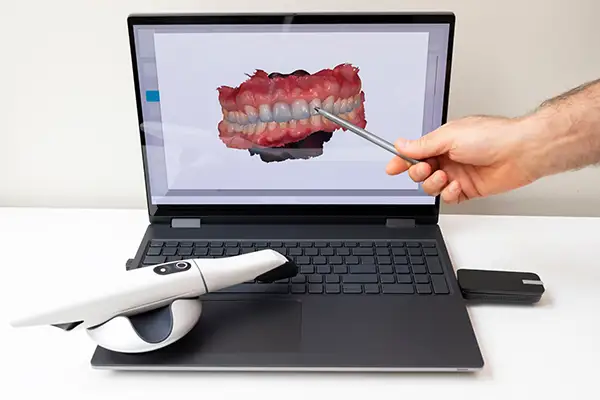 Close-up of a laptop screen showing a 3D model of teeth from a intraoral Camera, alongside a handheld dental scanner on a desk.