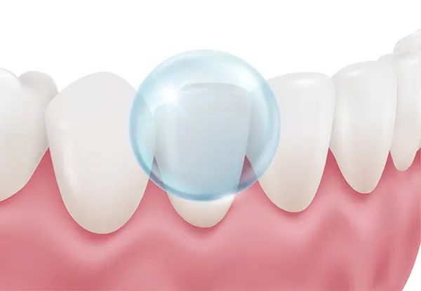 A big translucent bubble protecting a tooth demonstrating the effectiveness of fluoride.