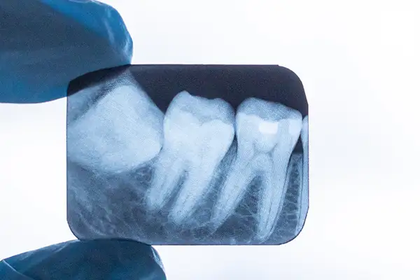 Dentist Grants Pass Or - When Do Wisdom Teeth Come In? 